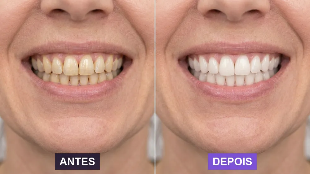 Antes e depois: dentes amarelados e depois mais brancos